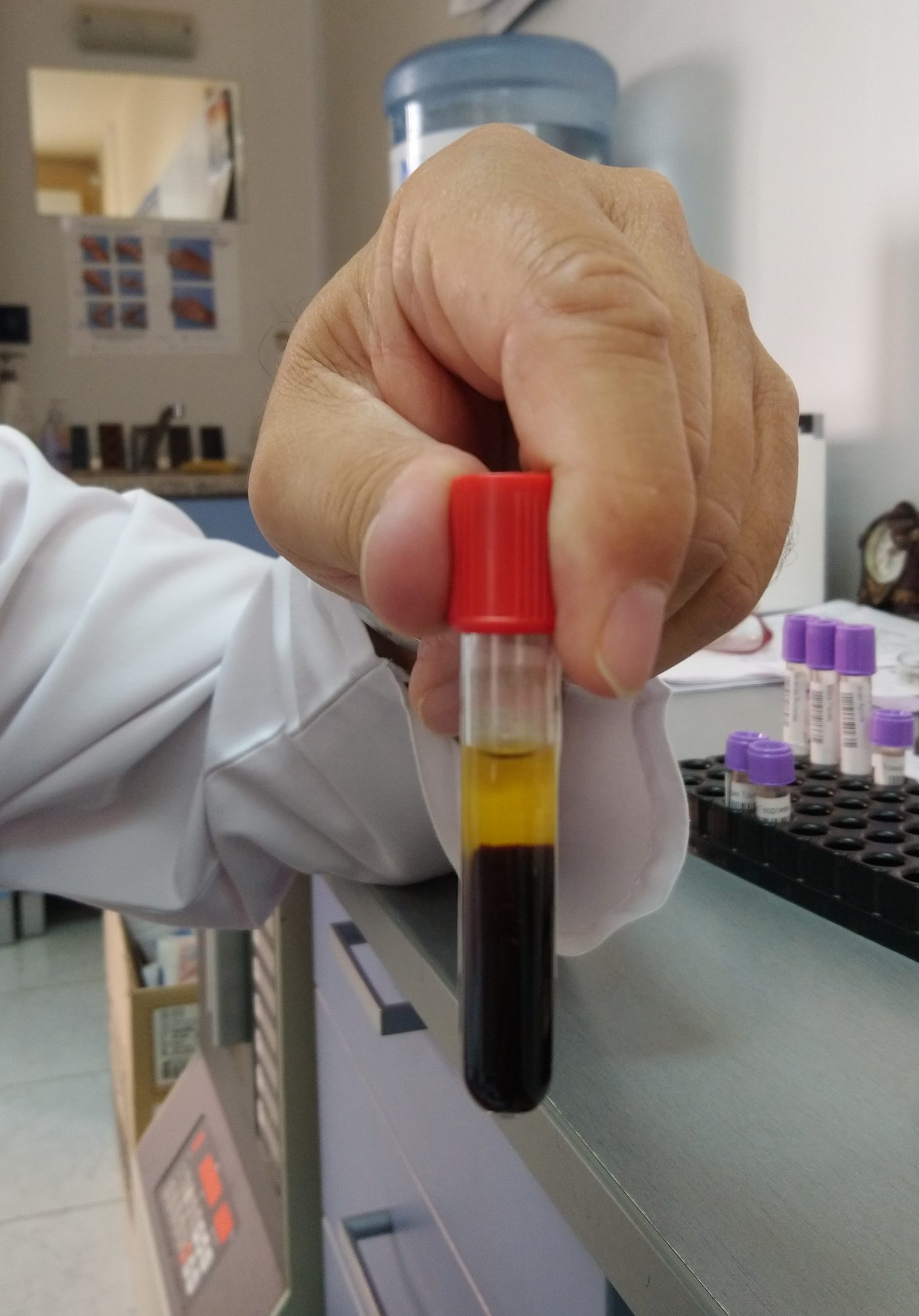 Centrifuged blood tube showing straw-colored serum separated from the dark red clot below