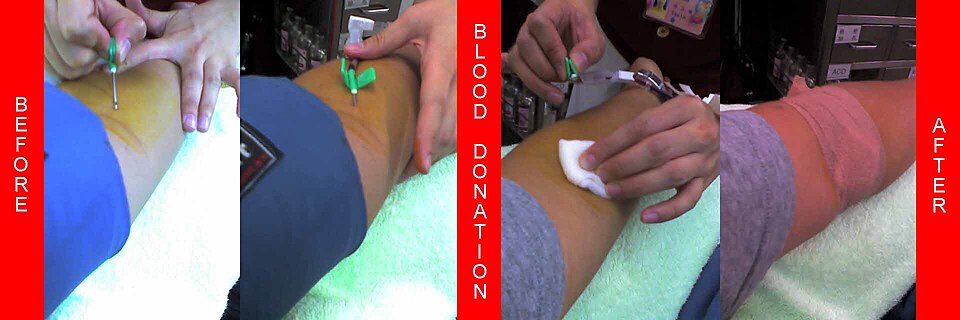 Four real photographs in one strip show a donor arm before, during, and after a platelet-apheresis donation; no face or donor record is visible.