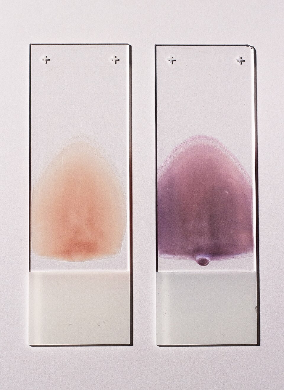 Two glass slides carry peripheral blood smears: a pale unstained smear on the left and a purple stained smear on the right.